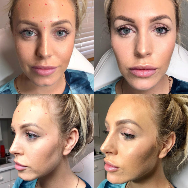 Cheeks, Chin, and Jawline FIllers in San Diego Skin & Skinnier
