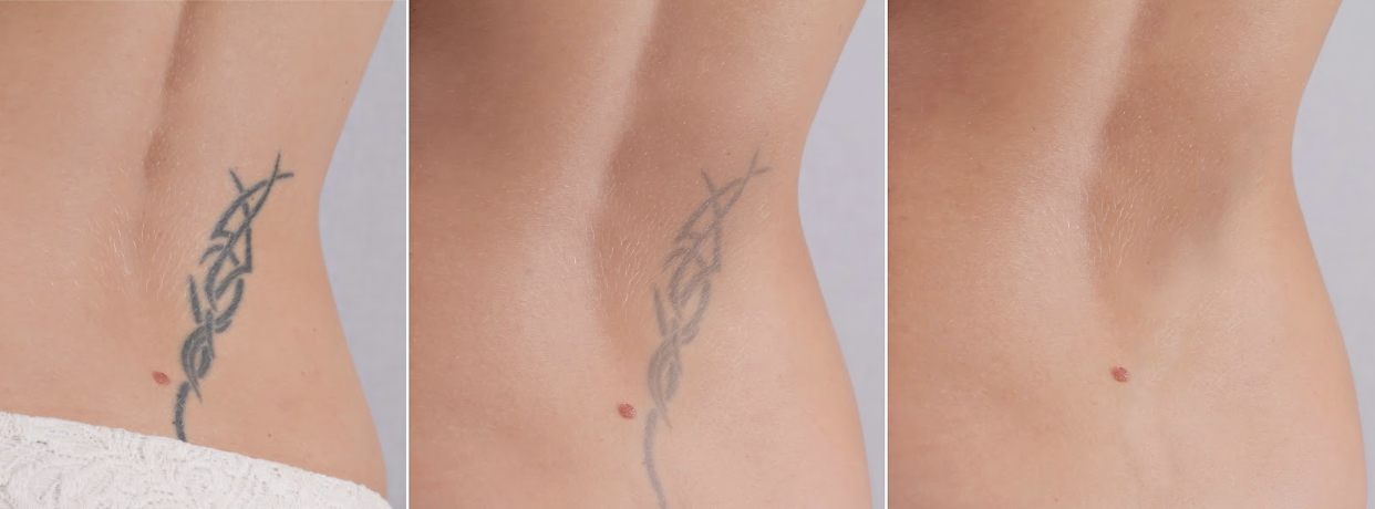 "Skin & Skinnier", San Diego Laser Tattoo Removal Dr